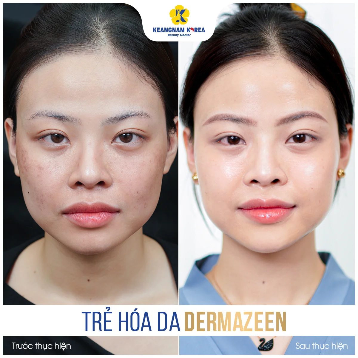 Home 42 BF-AF_Dermazeen3