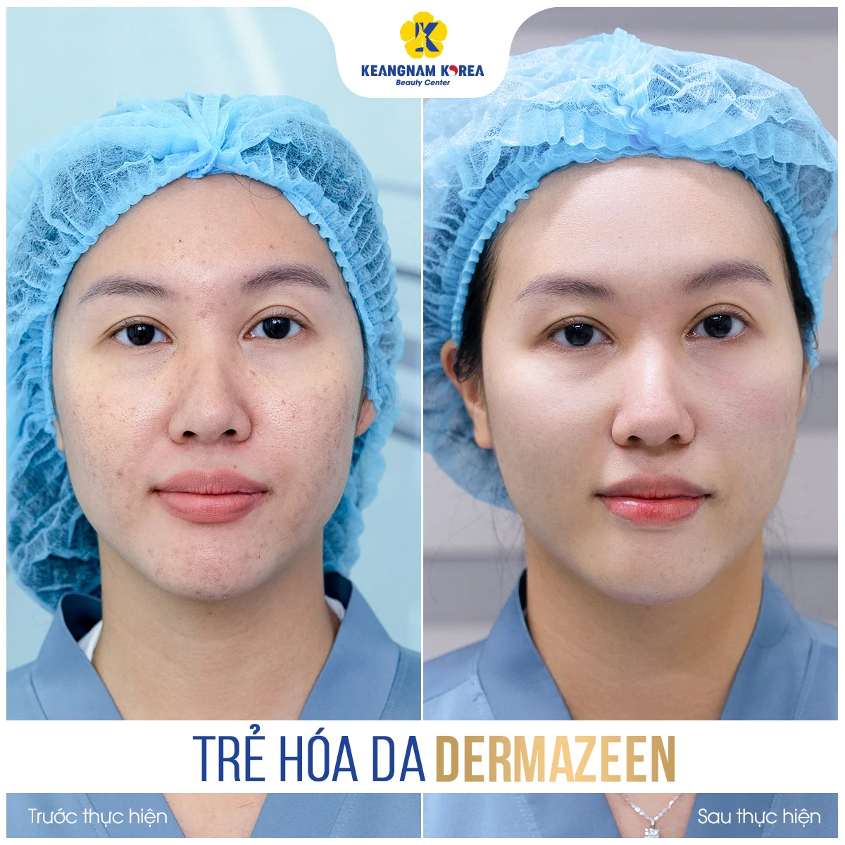 Home 40 BF-AF_Dermazeen7