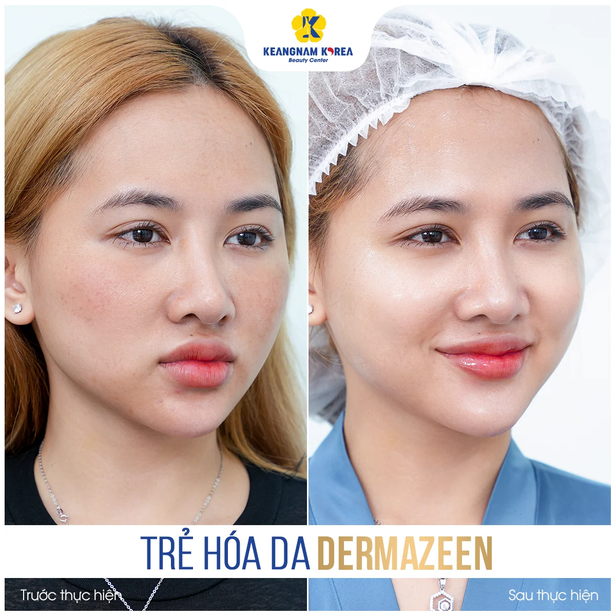 Home 44 BF-AF_Dermazeen8
