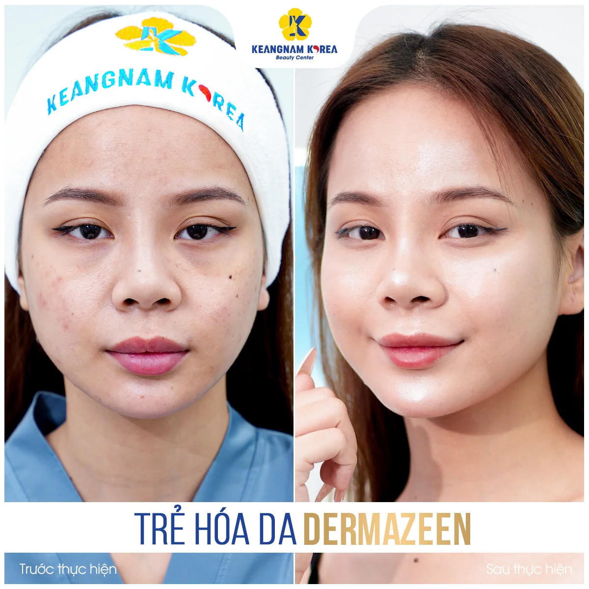 Home 43 BF-AF_Dermazeen9