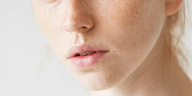 How to Treat Melasma on Cheeks at Home: 4 Effective Ways to Fade Dark Spots 1 What Is Melasma on the Cheeks?