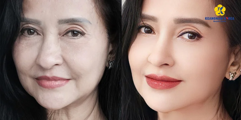 How to Get Glowing Skin: 6 Effective Ways for Naturally Radiant Skin 4 Endoscopic Facelift