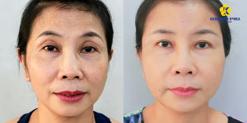 Eye Wrinkle Treatment: 7 Effective Ways to Reduce Wrinkles Around the Eyes 5 Eye Wrinkle Treatment Results at Keangnam Korea