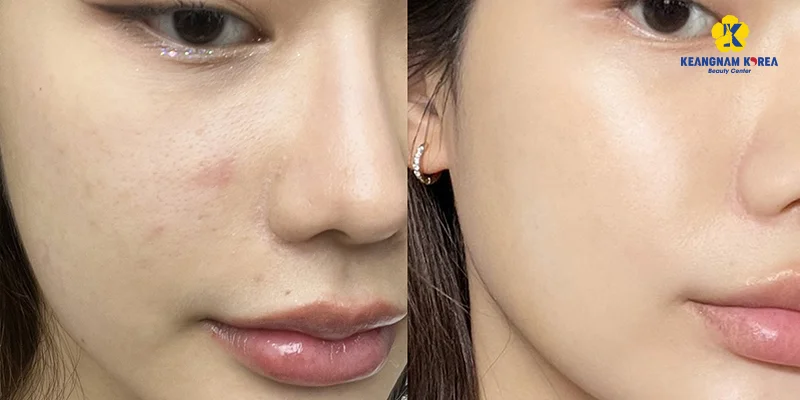 Mesotherapy Benefits: Is It Good for Your Skin? Full Guide 3 Mesotherapy benefits for acne scars and pigmentation