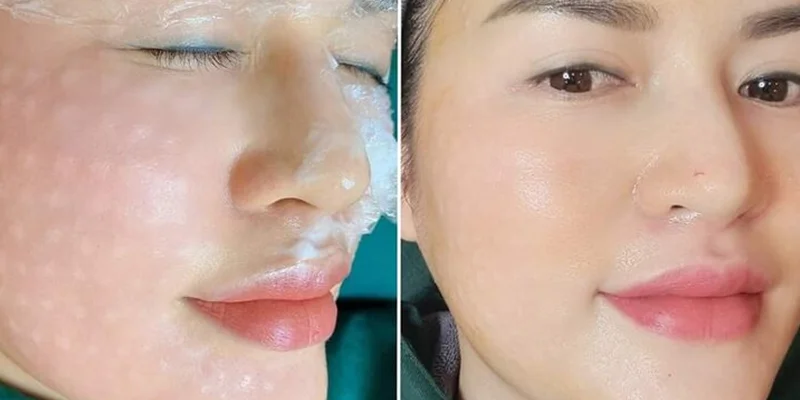 Mesotherapy Benefits: Is It Good for Your Skin? Full Guide 4 Manual mesotherapy injection technique with mild temporary swelling