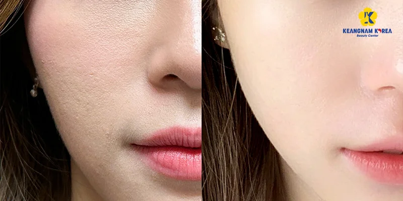 Mesotherapy Benefits: Is It Good for Your Skin? Full Guide 2 Mesotherapy benefits include smoother, more hydrated skin