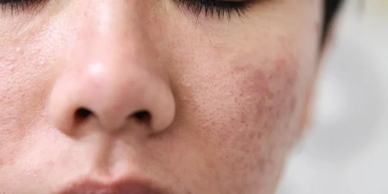 Mesotherapy Benefits: Is It Good for Your Skin? Full Guide 5 Who benefits from mesotherapy: aging and environmentally stressed skin