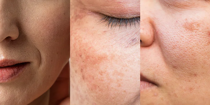 What Is Mesotherapy? Who Should (and Shouldn't) Get It 2 Who should get mesotherapy: ideal candidates for the treatment