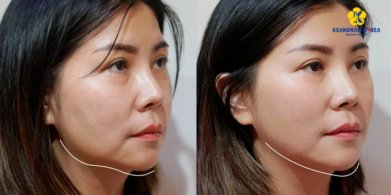 Mesotherapy or Endoscopic Facelift: Which Skin Fix? 5 Before and after results of endoscopic facelift