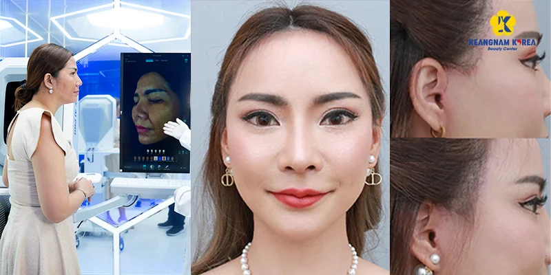 Mesotherapy or Endoscopic Facelift: Which Skin Fix? 3 AI-assisted endoscopic facelift procedure
