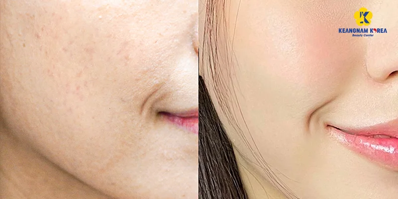Mesotherapy Benefits: Is It Good for Your Skin? Full Guide 6 Mesotherapy benefits visible in skin renewal results at Keangnam Korea