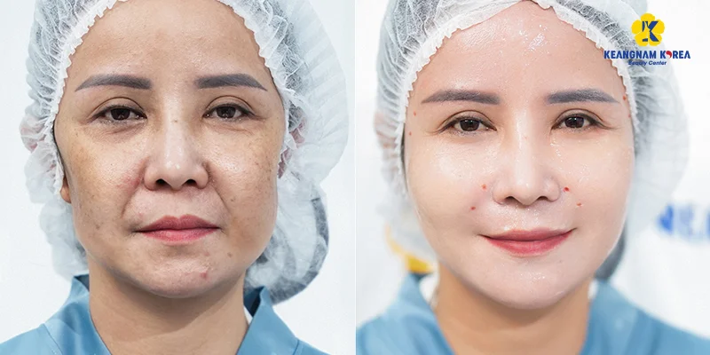 What's In a Skin Booster? PRP, PDRN, Exosome & HA Explained 4 Exosome skin booster results firming cheek area