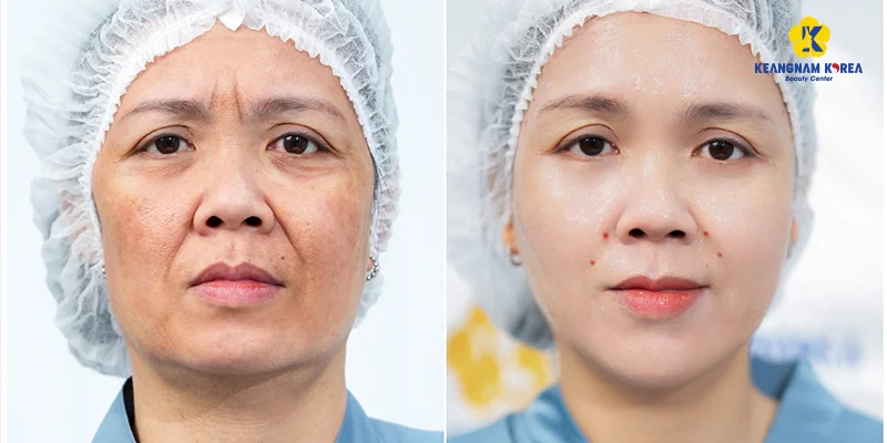 Mesotherapy or Endoscopic Facelift: Which Skin Fix? 6 Mesotherapy results for smoother, radiant skin
