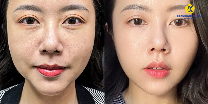 What's In a Skin Booster? PRP, PDRN, Exosome & HA Explained 5 Skin booster results smoothing smile lines