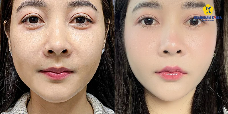 Best Mesotherapy in Ho Chi Minh City: Where to Go? 5 Younger-looking skin after mesotherapy in Ho Chi Minh City