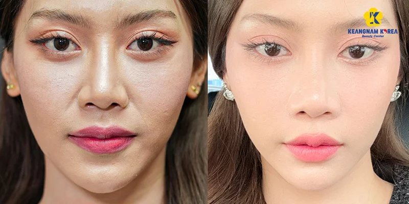 Best Mesotherapy in Ho Chi Minh City: Where to Go? 6 Real mesotherapy results at Keangnam Korea, Ho Chi Minh City