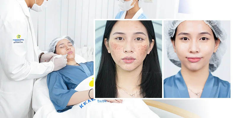 Mesotherapy Side Effects: Is It Safe? Full Safety Guide 2 Cheek area results after mesotherapy treatment at Keangnam Korea - mesotherapy side effects