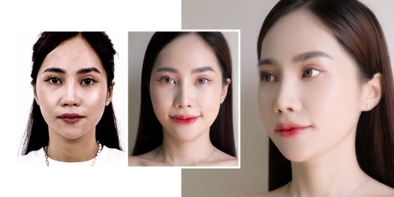 Best Mesotherapy in Ho Chi Minh City: Where to Go? 2 Mesotherapy technique delivering nutrients into the dermis layer