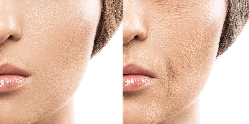 What Is Mesotherapy? Who Should (and Shouldn't) Get It 3 Overview of mesotherapy advantages for skin rejuvenation