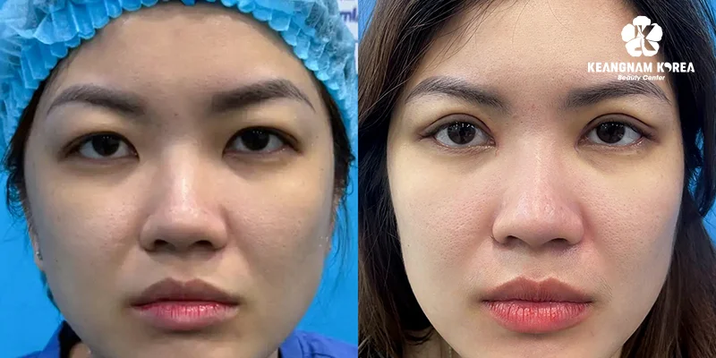 Surgery to Make Eyes Bigger: 3 Proven Methods Explained 4 Lateral canthoplasty outer eye corner extension