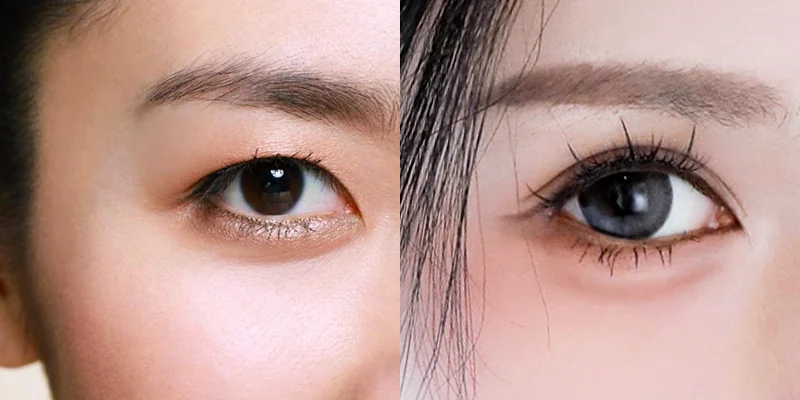 Surgery to Make Eyes Bigger: 3 Proven Methods Explained 2 Surgery to make eyes bigger before and after results