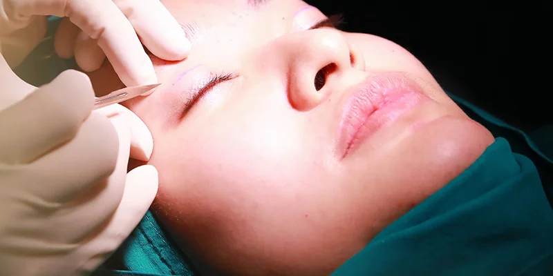 Surgery to Make Eyes Bigger: 3 Proven Methods Explained 3 Double eyelid surgery incision placement