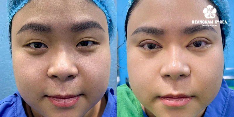 Surgery to Make Eyes Bigger: 3 Proven Methods Explained 6 Real results after eye enlargement surgery at Keangnam Korea