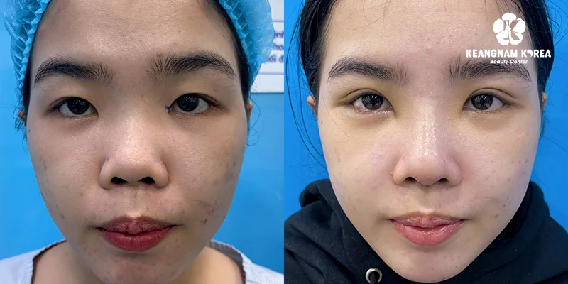 Surgery to Make Eyes Bigger: 3 Proven Methods Explained 5 Eyes appear more alert and defined after eyelid surgery