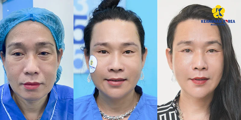 Massage for Under Eye Bags: 3 Techniques That Really Help 5 under eye bags