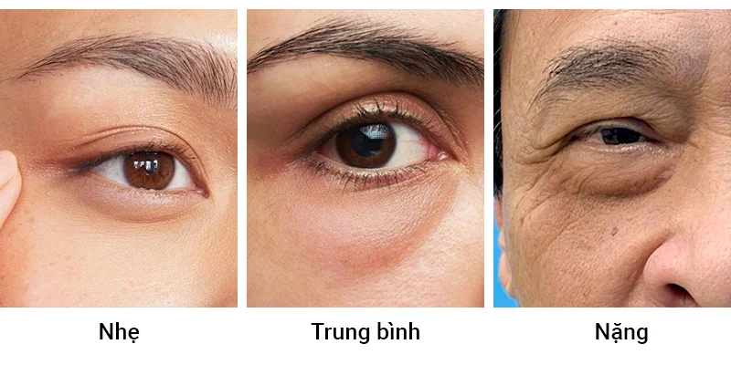 Under Eye Bags Treatments: Causes, Severity Levels & Real 3 Under eye bags severity levels comparison