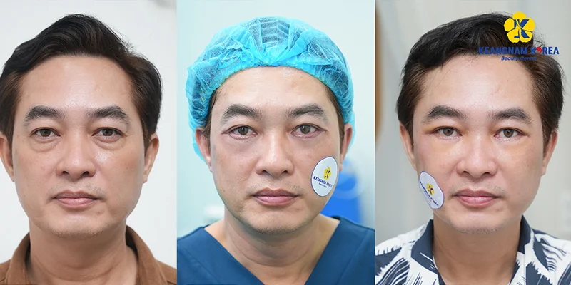 Massage for Under Eye Bags: 3 Techniques That Really Help 2 Why Massage Works on One but Not the Other