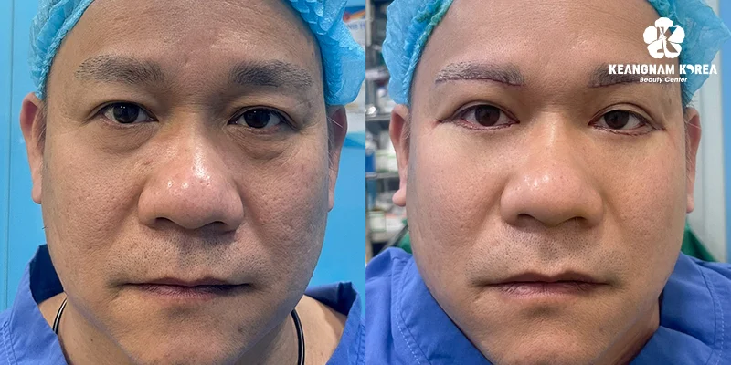 Under Eye Bags Treatments: Causes, Severity Levels & Real 7 Fresher facial appearance after under eye bags treatment