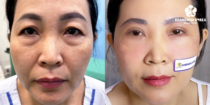 Under Eye Bags Treatments: Causes, Severity Levels & Real 8 Natural-looking results with no visible surgical trace