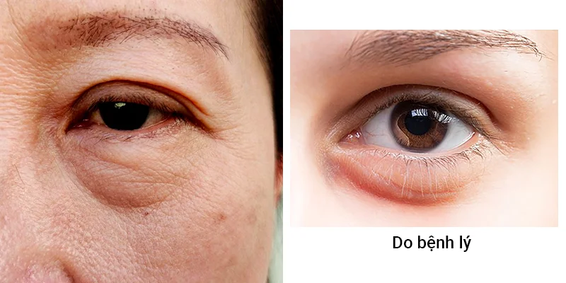 Under Eye Bags Treatments: Causes, Severity Levels & Real 2 Identifying the cause of under eye bags for proper treatment