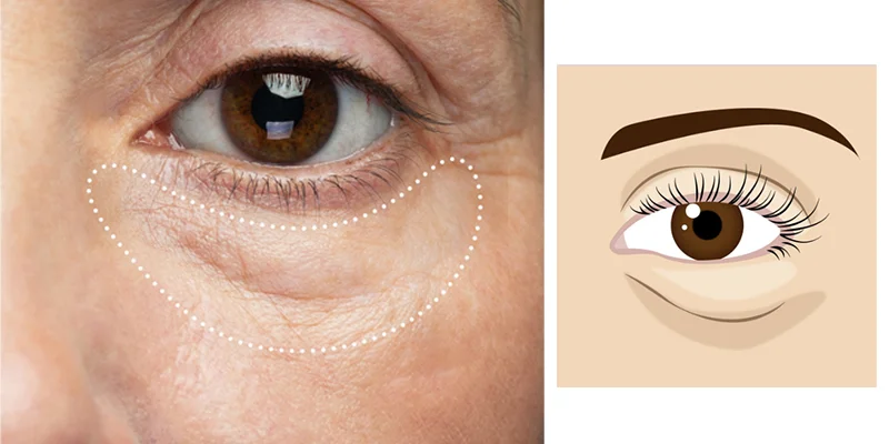 Under Eye Bags Treatments: Causes, Severity Levels & Real 1 What causes under eye bags to form