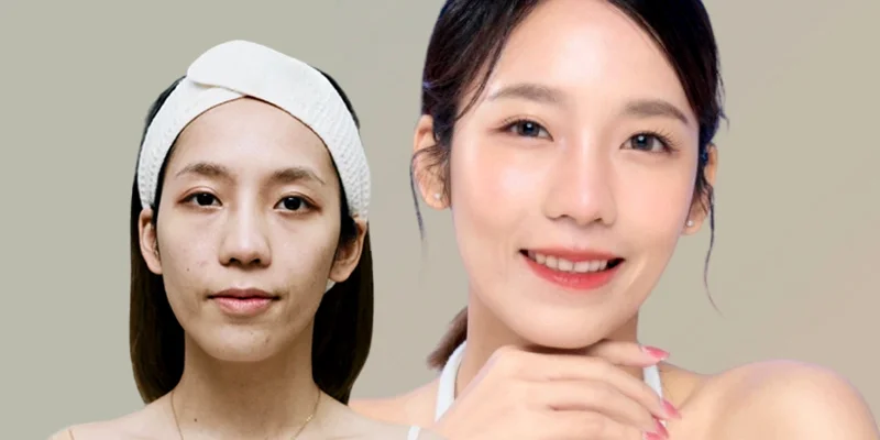 Hyaluronic Acid Skin Booster: Benefits, Duration & Safety 3 Before and after results with an HA skin booster