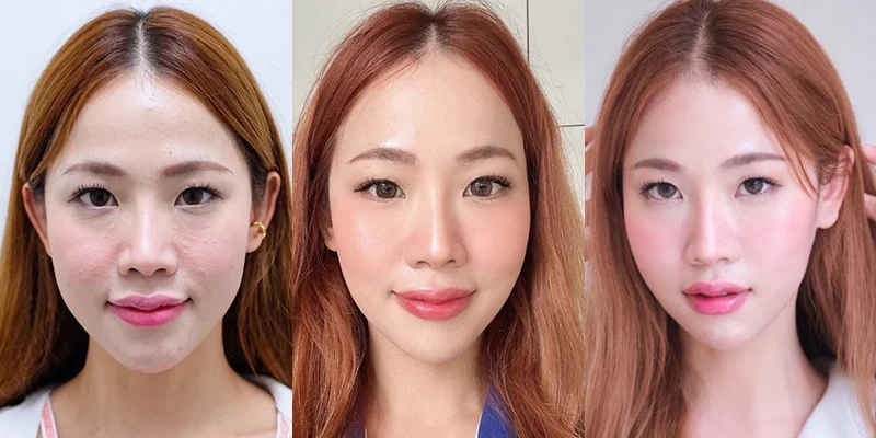 How Long Does Mesotherapy Last? Full Duration Guide 3 Factors affecting mesotherapy duration, including active ingredient
