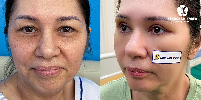Under Eye Bags Treatments: Causes, Severity Levels & Real 6 Real results after eye bag surgery at Keangnam Korea