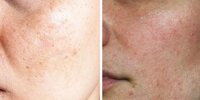 Signs of Melasma: 5 Early Clues and What to Do Next 2 Signs of melasma spreading across the cheeks