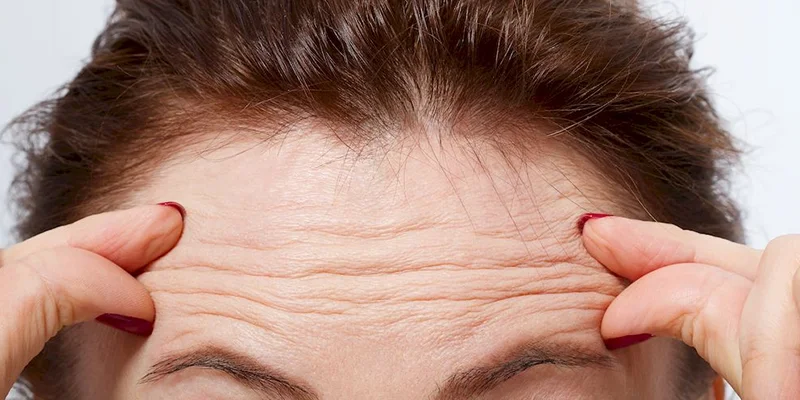 How to Get Rid of Forehead Wrinkles: 5 Proven Methods 1 Early forehead wrinkles on a young woman