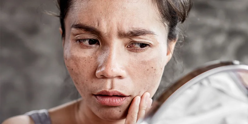 Signs of Melasma: 5 Early Clues and What to Do Next 1 Early signs of melasma on the face