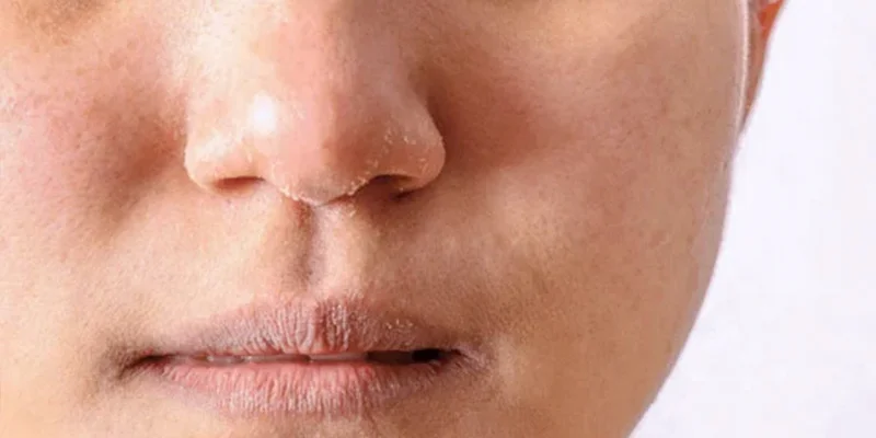 Signs of Melasma: 5 Early Clues and What to Do Next 3 Skin sensitivity alongside signs of melasma