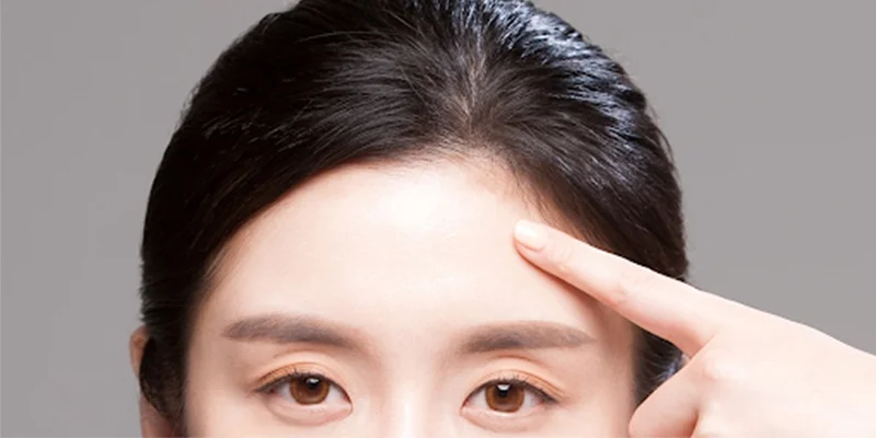 Forehead Wrinkle Treatment in Ho Chi Minh City 1 Forehead wrinkle treatment in Ho Chi Minh City
