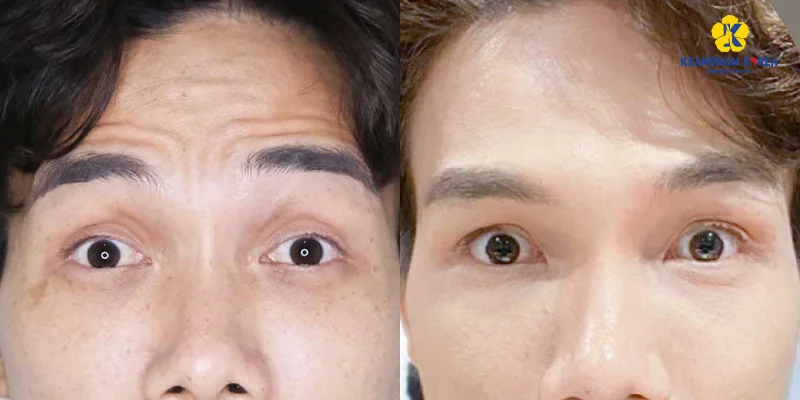 Horizontal Forehead Lines: Causes and Treatments That Work 4 Skin regeneration treatment for horizontal forehead lines