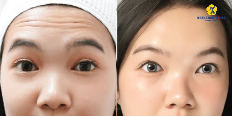Horizontal Forehead Lines: Causes and Treatments That Work 5 Doctor assessing horizontal forehead lines before treatment
