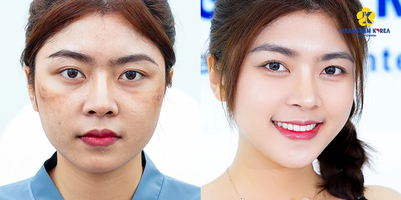 Mesotherapy Cost: Prices, Sessions and What Affects Them 4 Needle-free mesotherapy and its cost