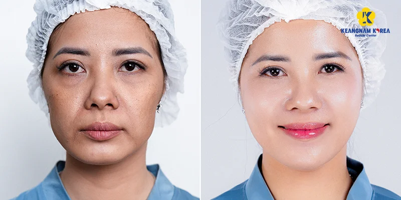 Mesotherapy Cost: Prices, Sessions and What Affects Them 5 Needle-free mesotherapy