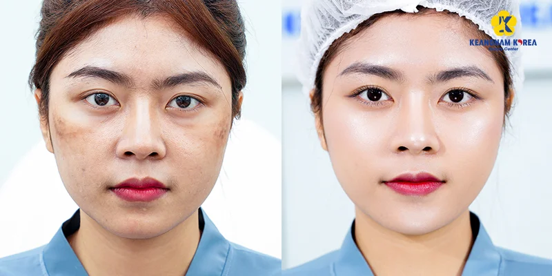 Forehead Wrinkle Treatment in Ho Chi Minh City 5 Meso SPI session for forehead wrinkle treatment