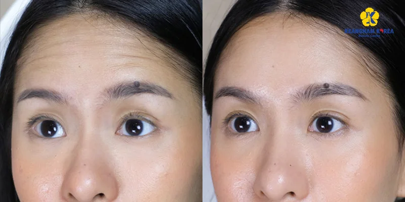 Horizontal Forehead Lines: Causes and Treatments That Work 3 Early horizontal forehead lines that are easier to treat