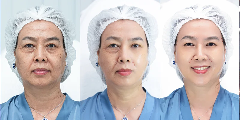 Forehead Wrinkle Treatment in Ho Chi Minh City 7 Deep forehead lines before forehead wrinkle treatment